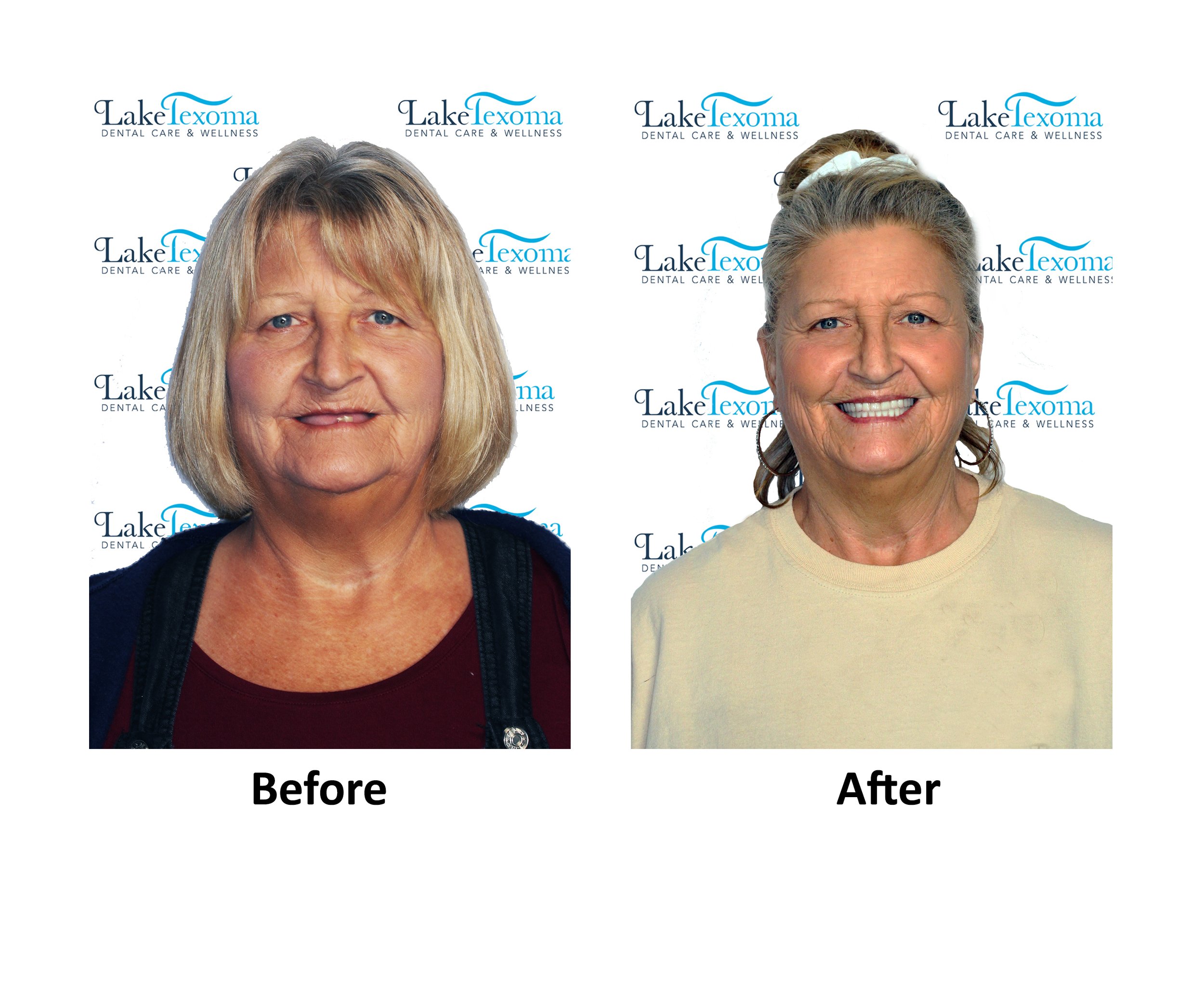 S Handlang - Dentures - Before After.jpg