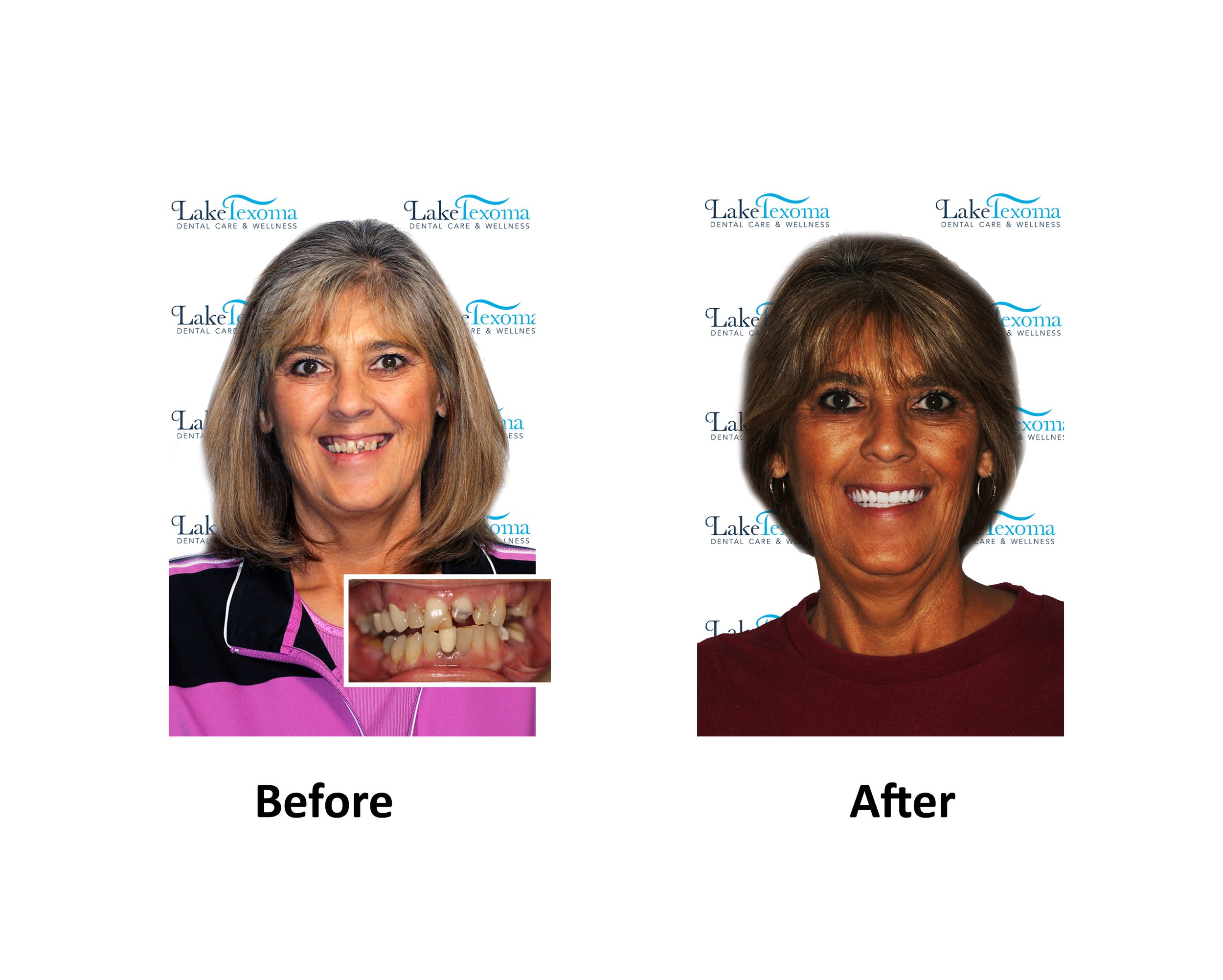 L White - Dentures - Before After.jpg