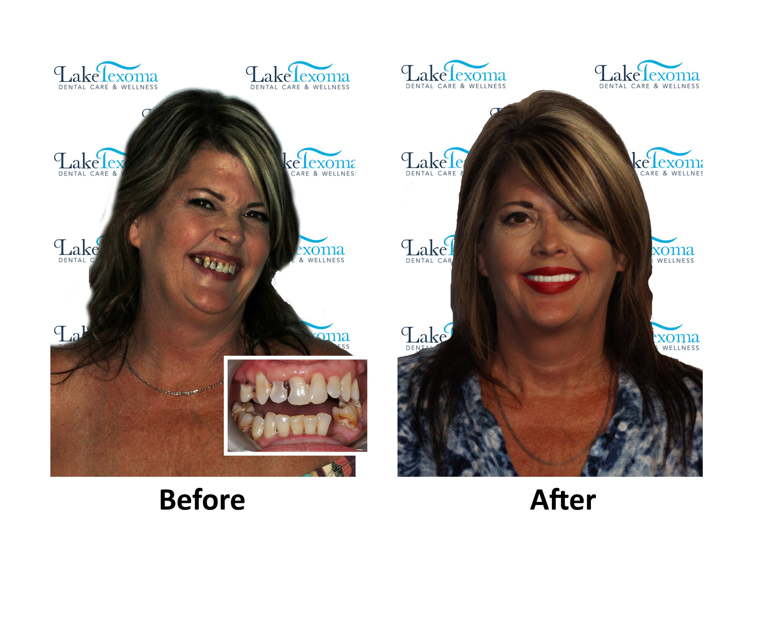 T Wallace - Implant Dentures - Before After .jpg