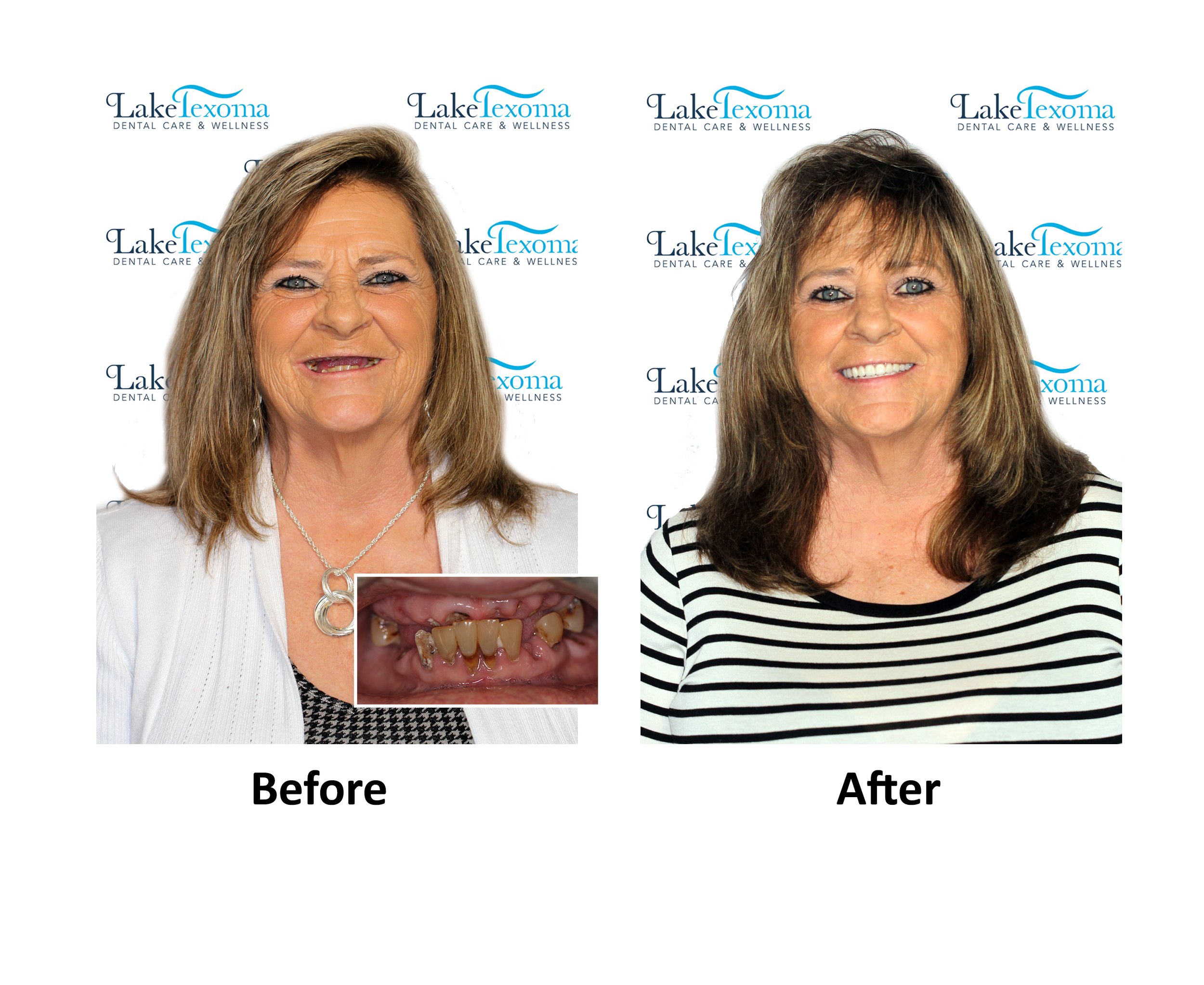 V Gunter - Dentures - Before After.jpg