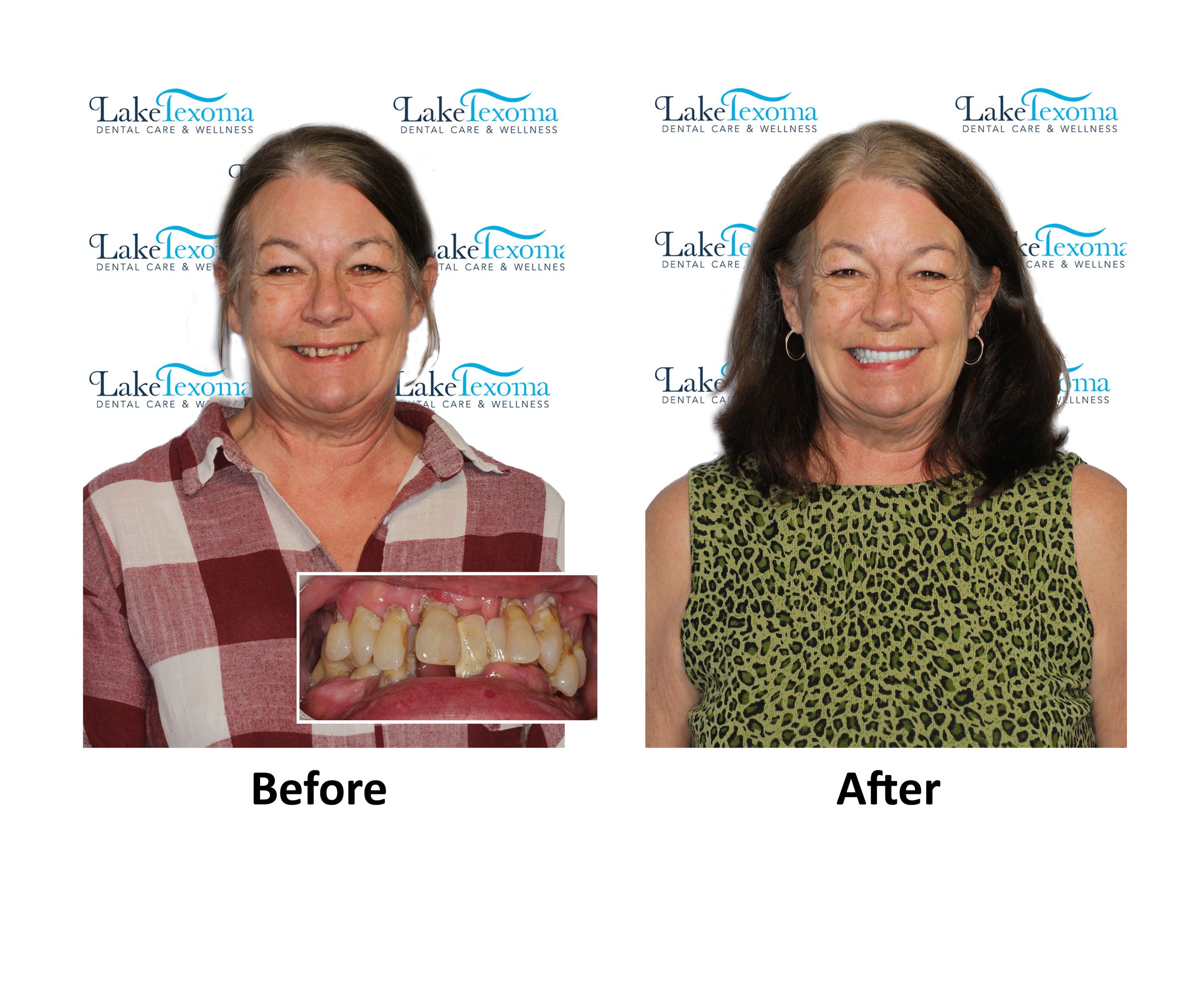 R Roman - Implant Dentures - Before After .jpg