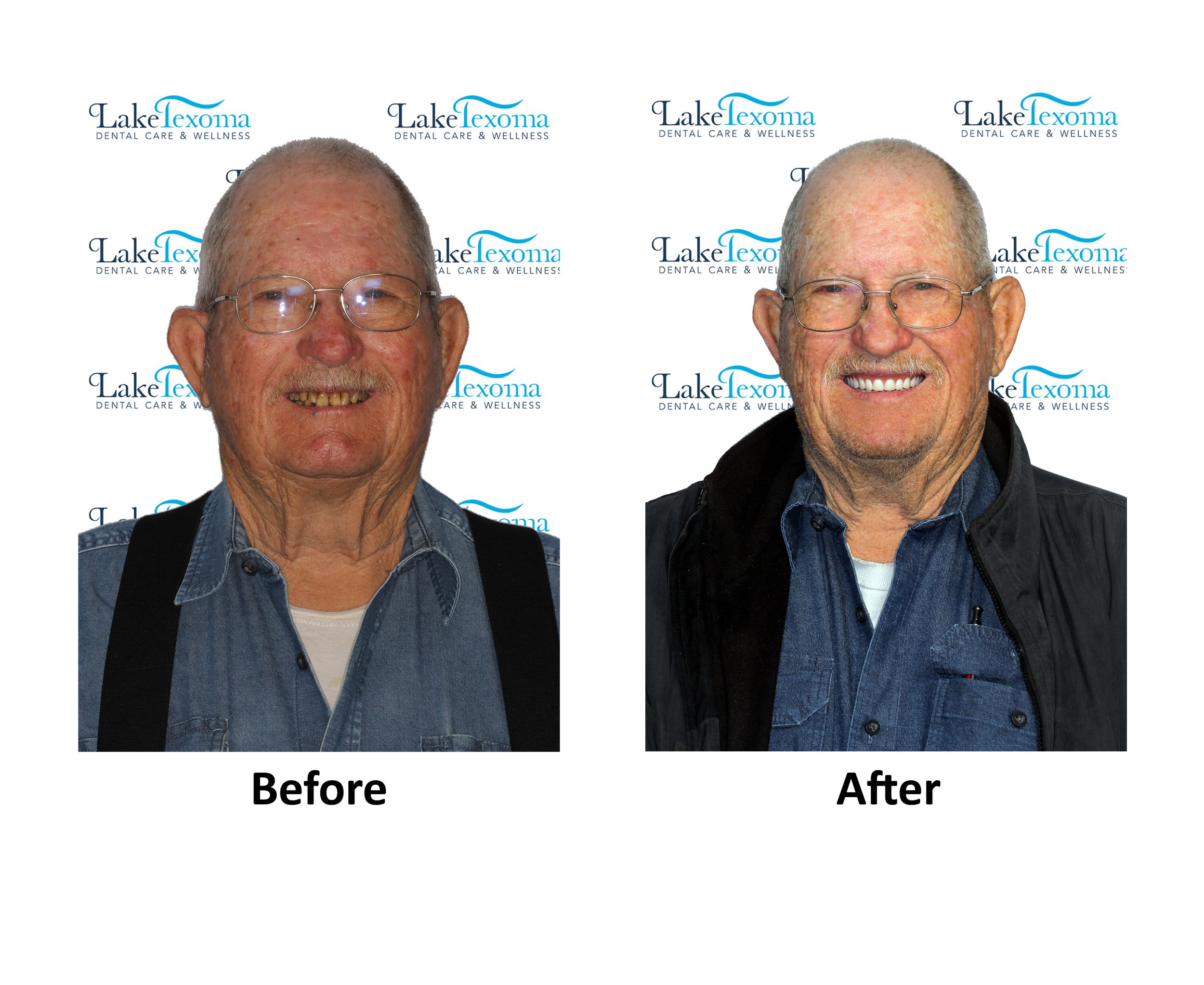 D England - Implant Dentures - Before After.jpg