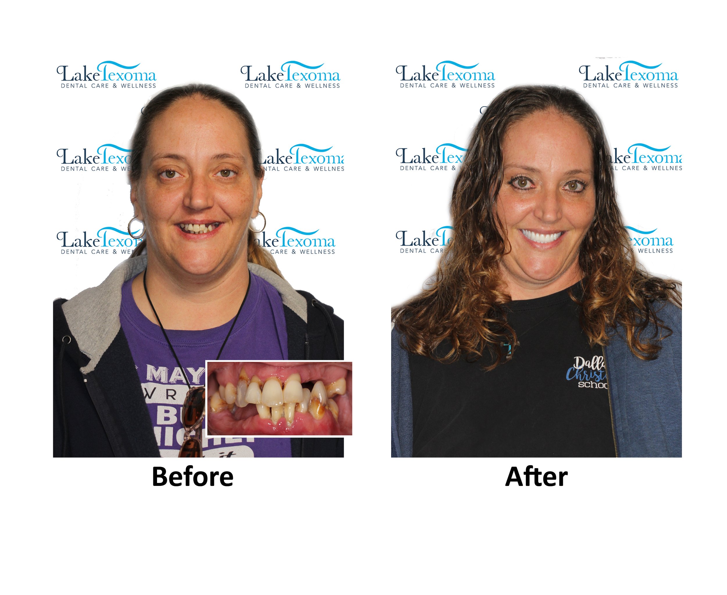 A Walling - Dentures - Before After.jpg