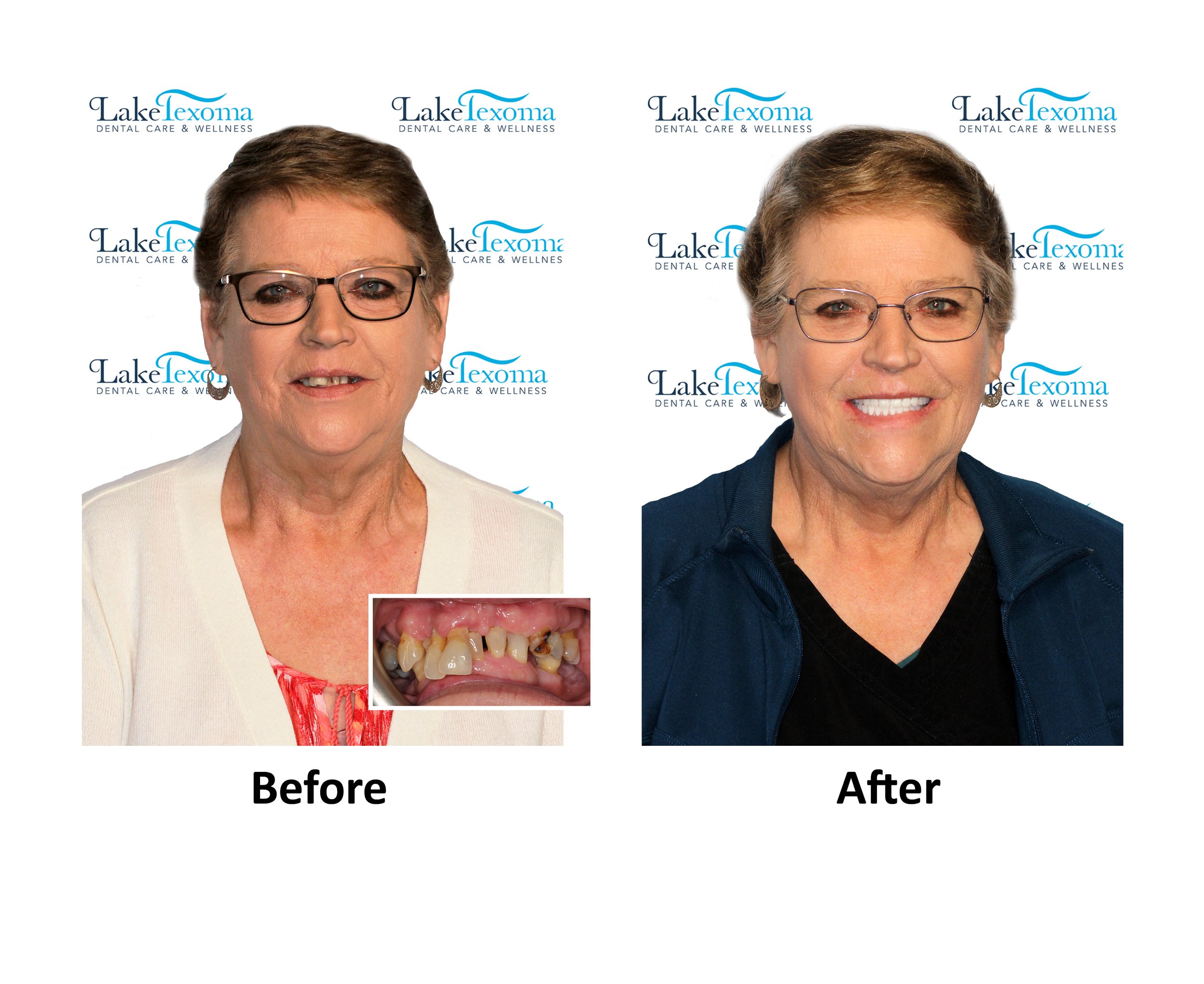 S Brown - Implant Dentures - Before After .jpg
