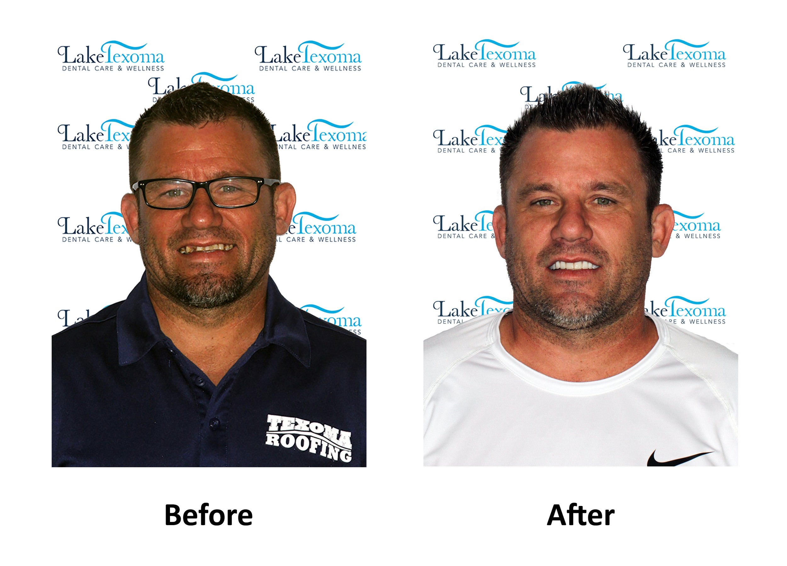 Cody A - Teeth in a Day - Before After.jpg