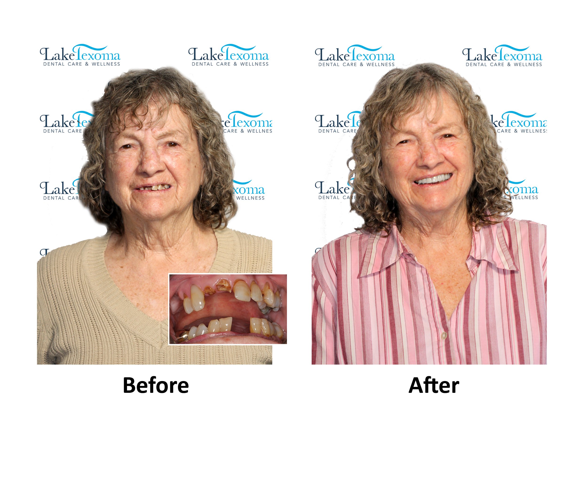 S McKinney - Dentures - Before After.jpg