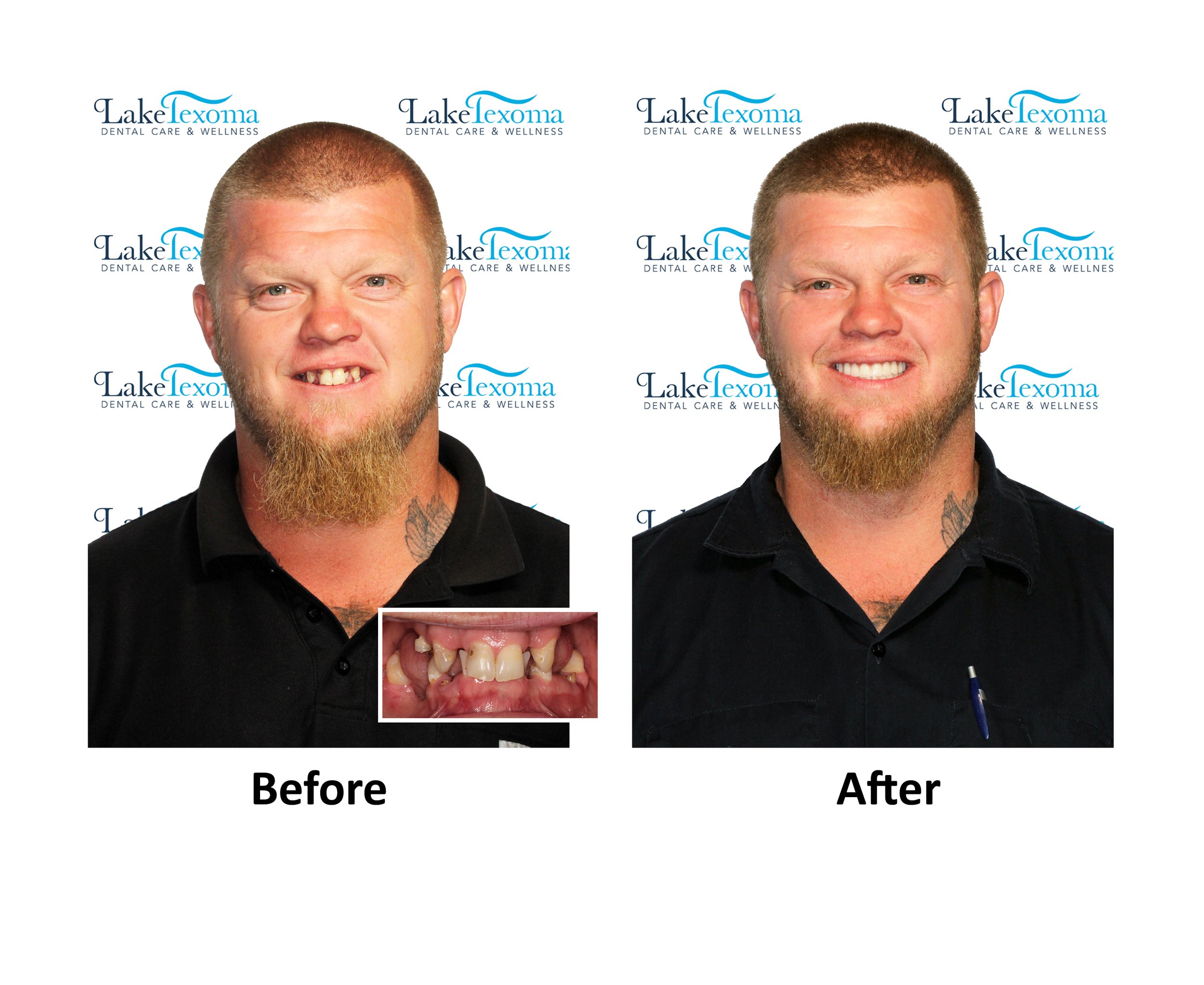 S Shubert - Implant Dentures - Before After.jpg