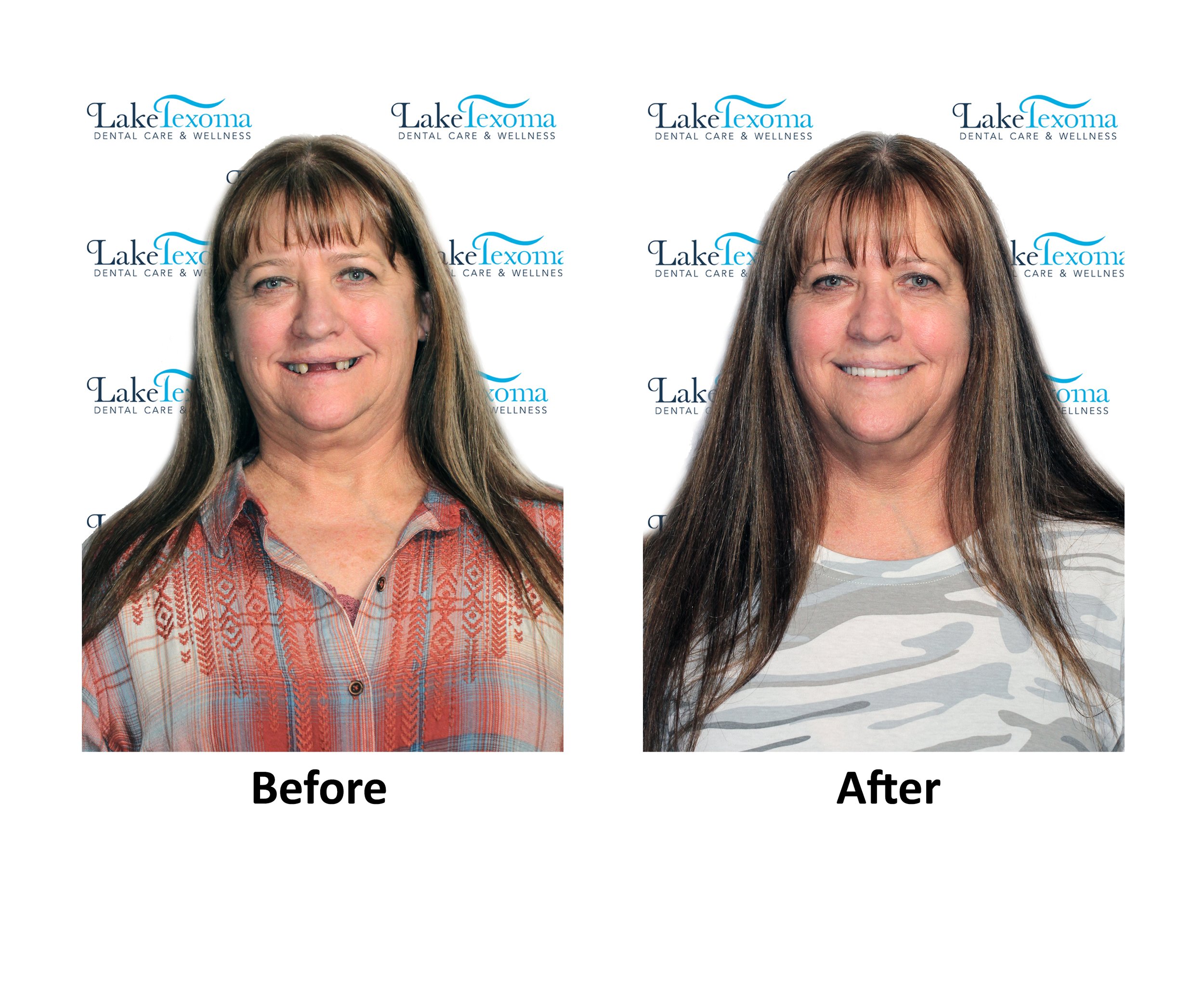 S Rains - Dentures - Before After.jpg