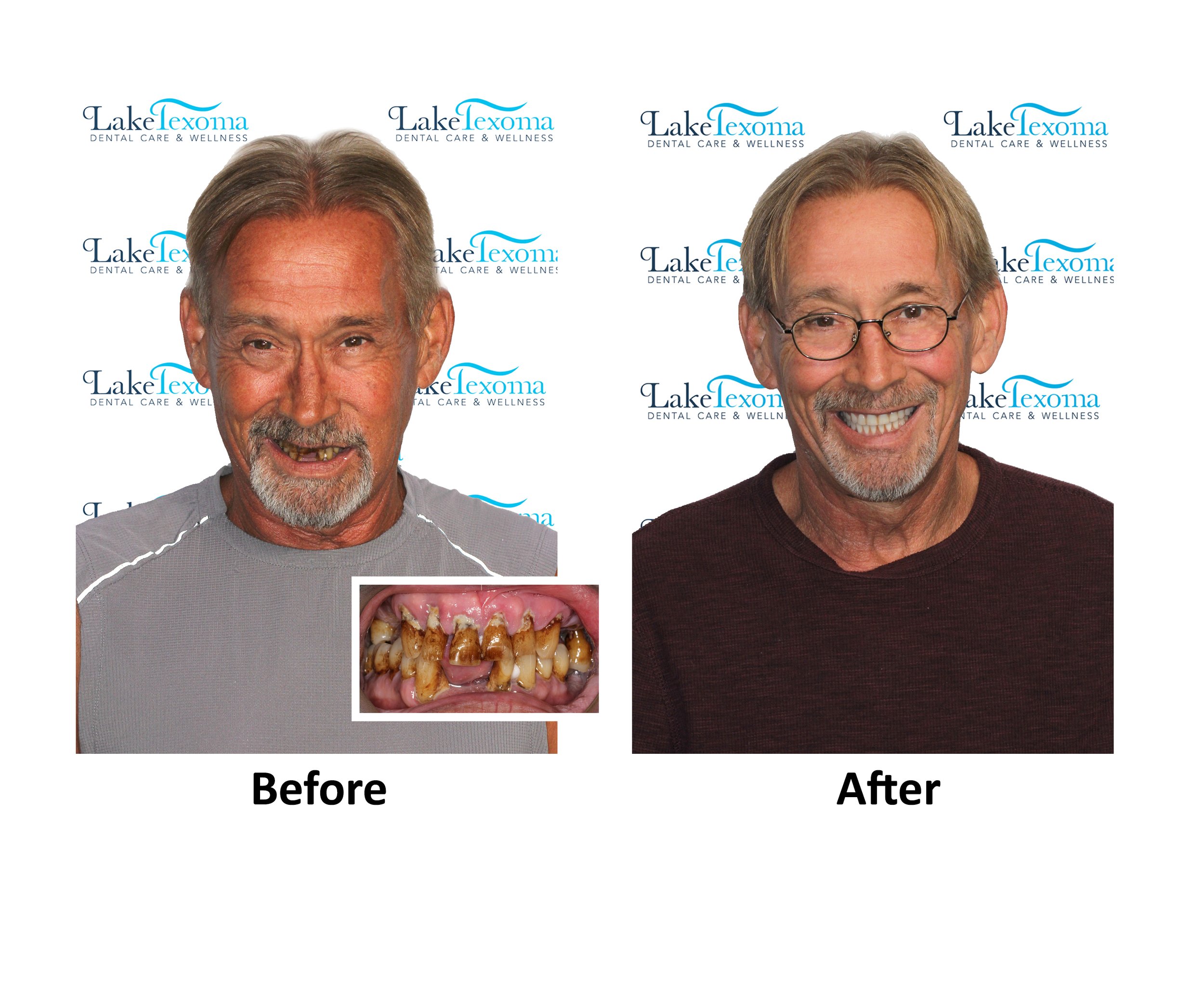 C Conklin- Dentures - Before After.jpg