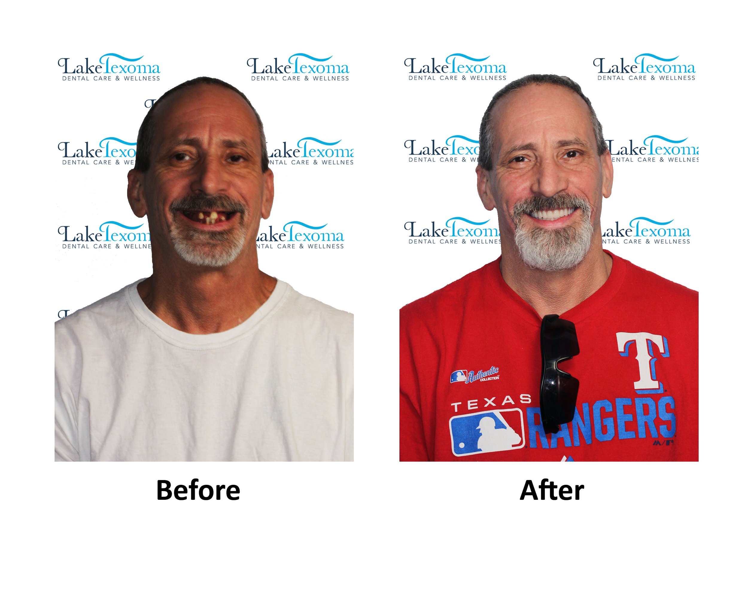 S Green - Dentures - Before After.jpg