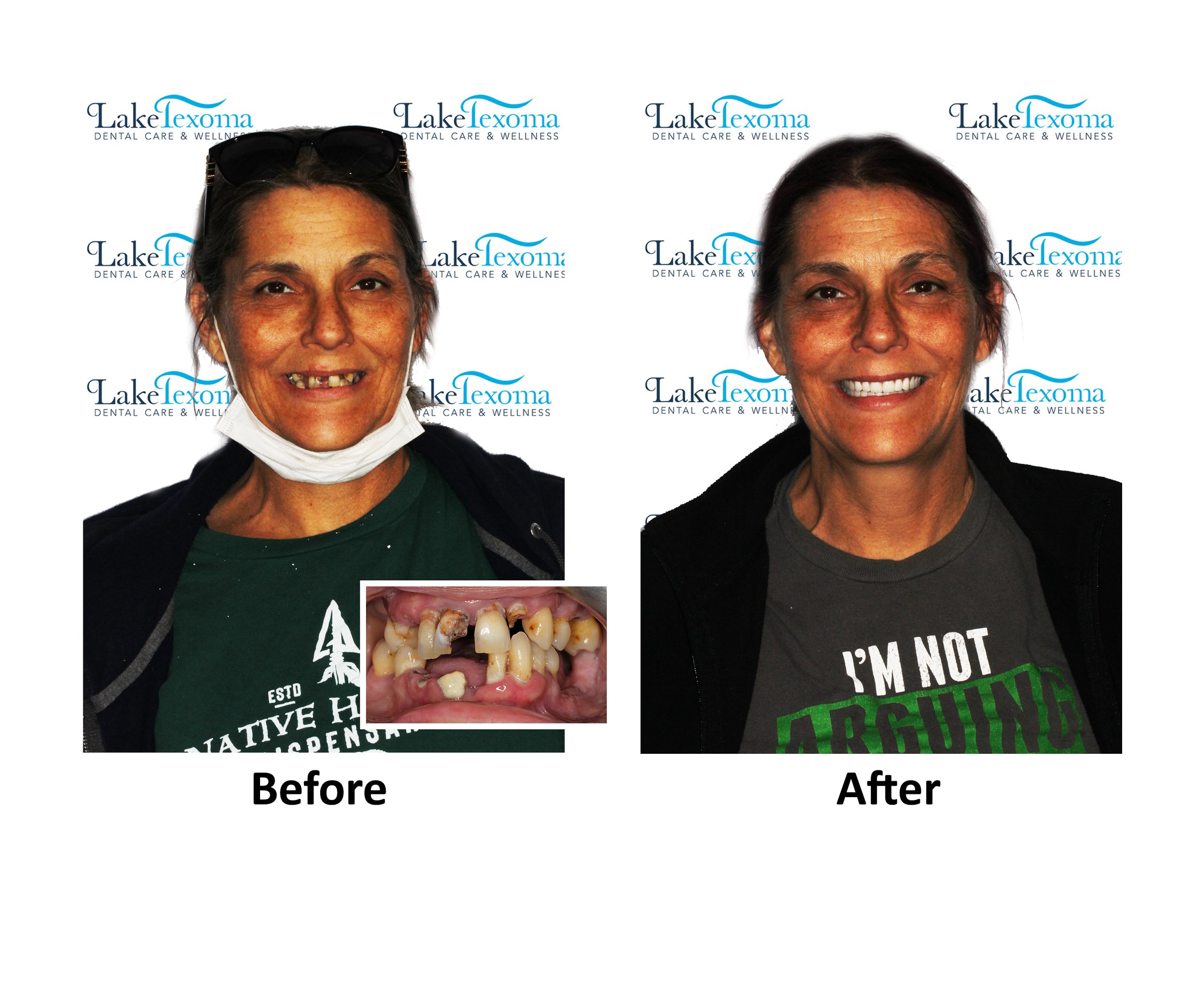 D Moore - Dentures - Before After.jpg