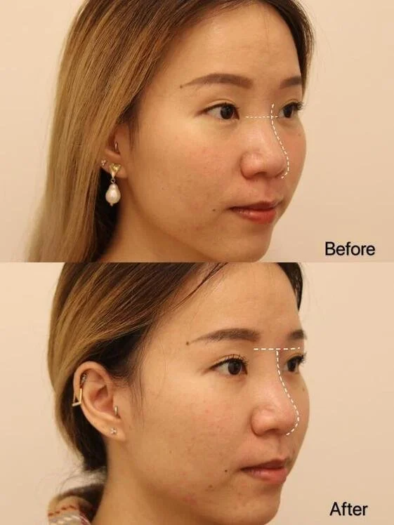My Hiko Nose Thread Lift Experience at The Clifford Clinic — WINTER CHEE
