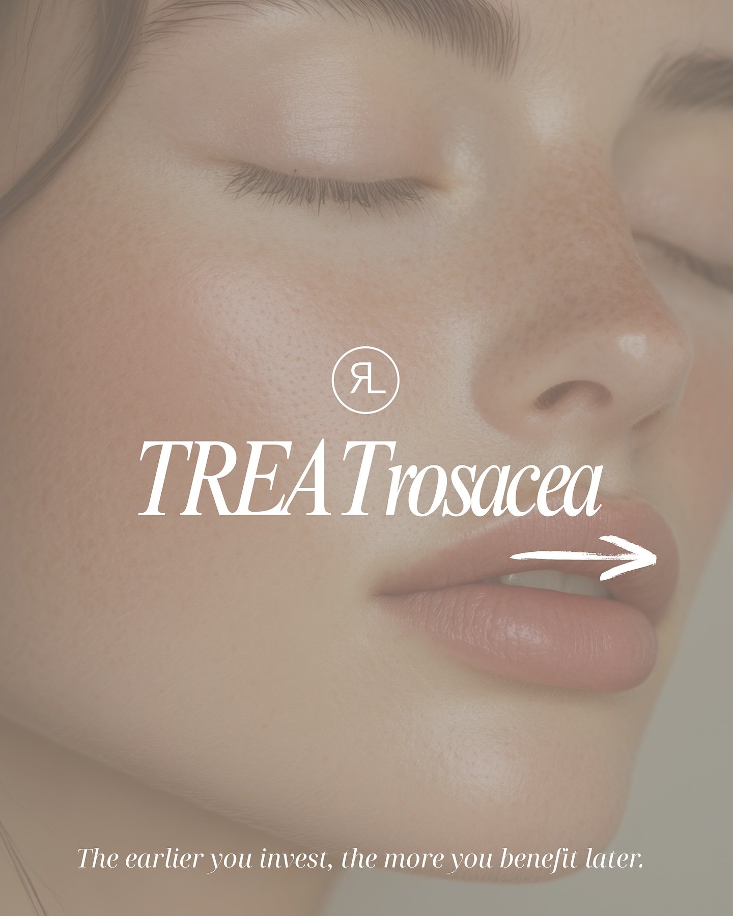 Say hello to radiant skin! 

At Rose &amp; Lily Spa Bar, we specialize in treating rosacea with the innovative Sylfirm X treatment. 

Marianne and our team are dedicated to helping you achieve the smooth, even complexion you deserve.

Don&rsquo;t let