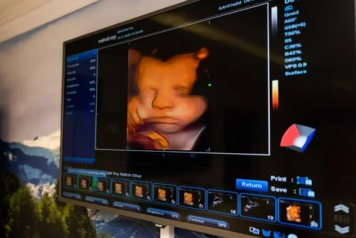 HD 4D ultrasound screen showing a clear image of a baby’s face during a scan at Imaginatal’s Bristol clinic