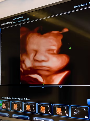 HD 4D baby scan showing a close-up ultrasound image of a baby’s face at Imaginatal clinic