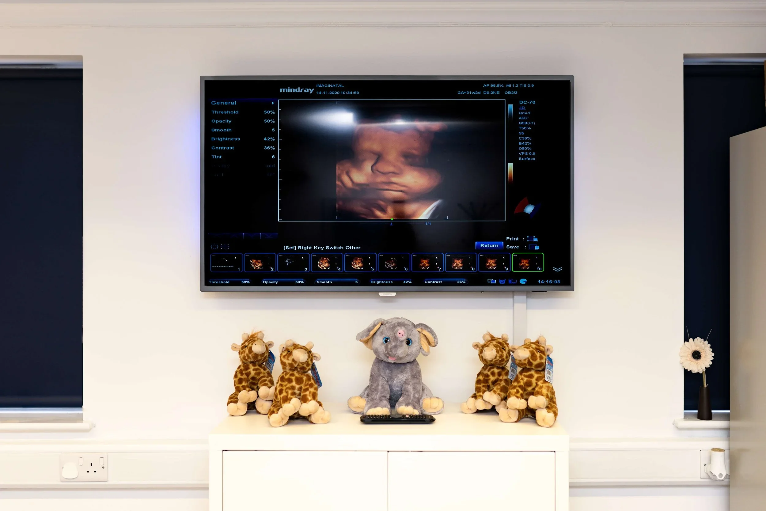 HD 4D baby ultrasound displayed on a clinic screen during a private pregnancy scan at Imaginatal