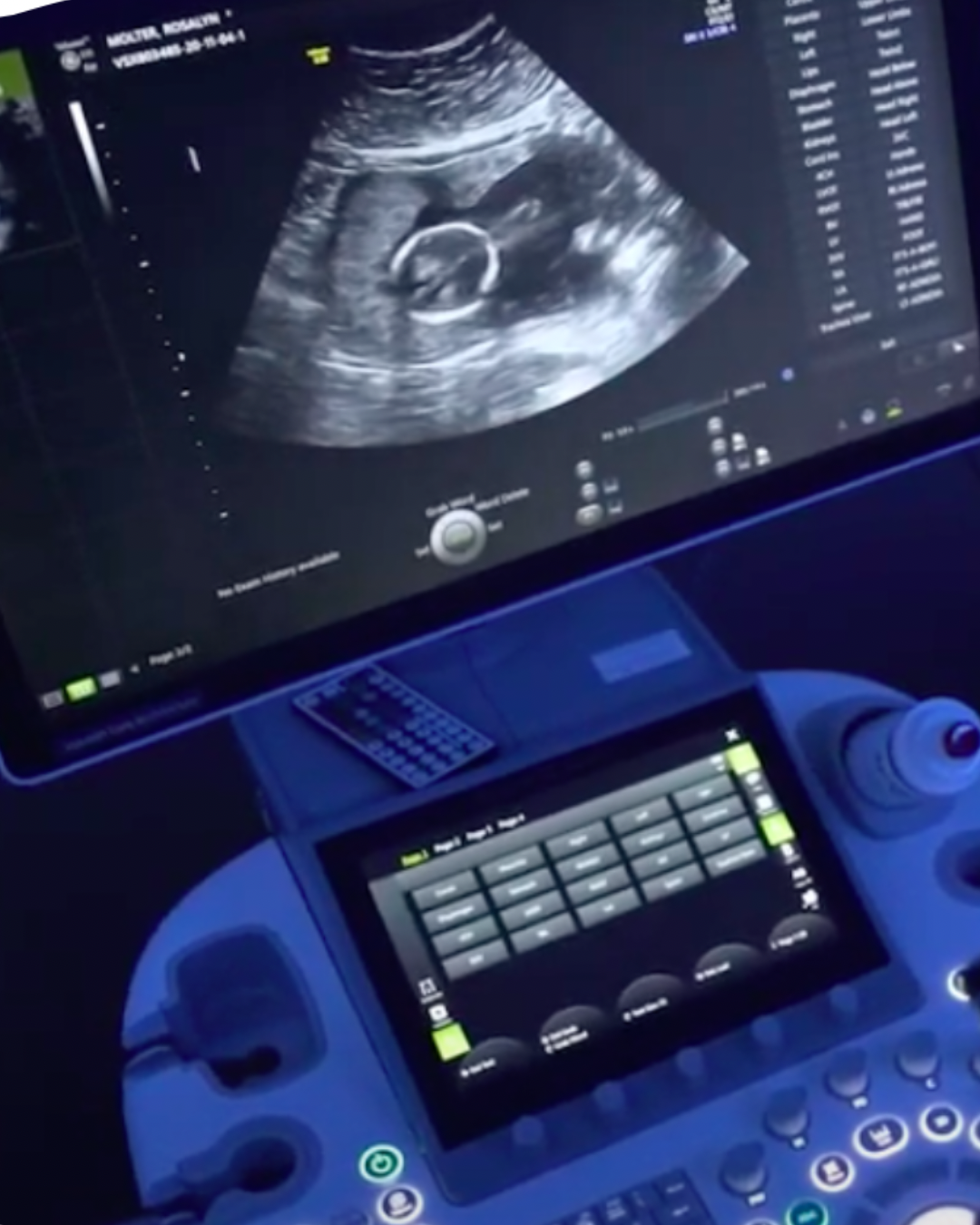 Ultrasound machine showing an early pregnancy scan of a baby at Imaginatal’s Bristol clinic