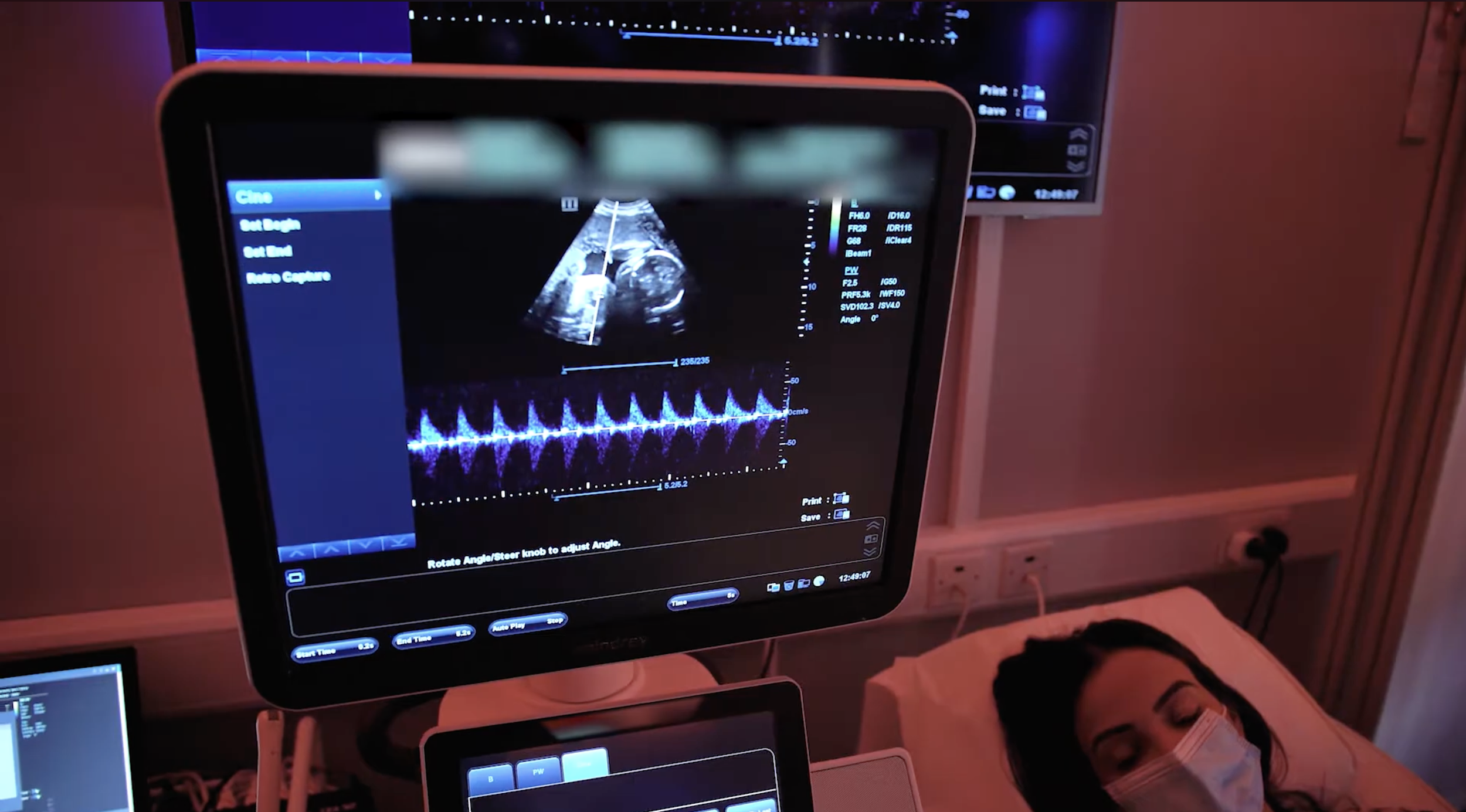 Pregnancy ultrasound scan showing baby and heartbeat on the monitor while a patient lies on the scan bed.