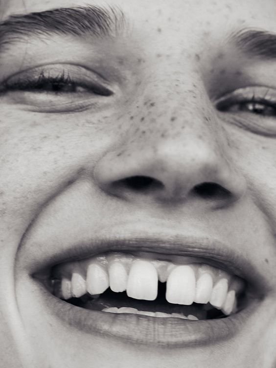 Northern_Beaches_Teeth-Whitening_Mobile_Treatments.jpeg