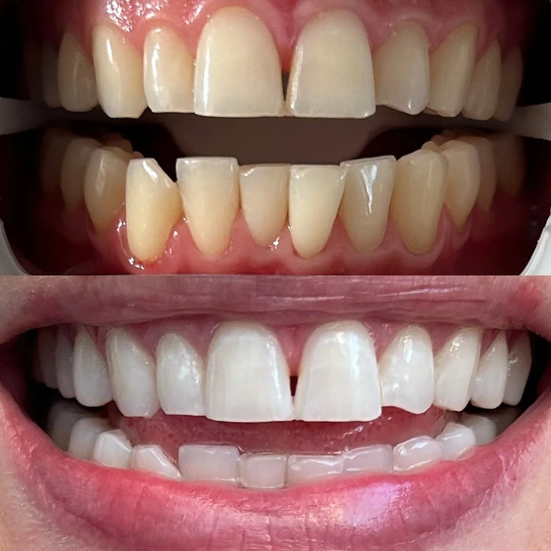 Our Ultra White Treatment for Jess ❤️&zwj;🔥⁣
⁣⁣
⁣2 seperate sittings, one week apart to achieve the whitest results possible. ⁣
⁣⁣
⁣Book now via the link in bio.