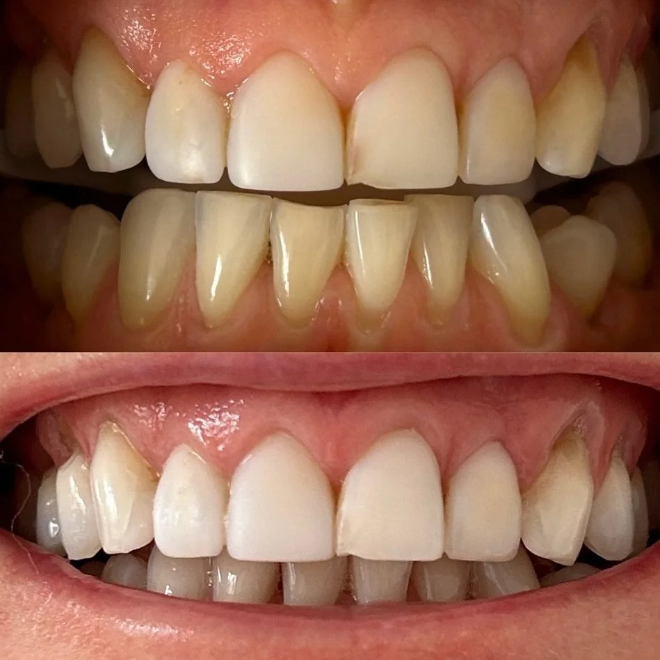 Our signature &lsquo;Triple White Treatment&rsquo; glow for Iza&rsquo;s first ever teeth whitening treatment. 

Instant results and a confidence boost for to celebrate her special birthday. 🤍