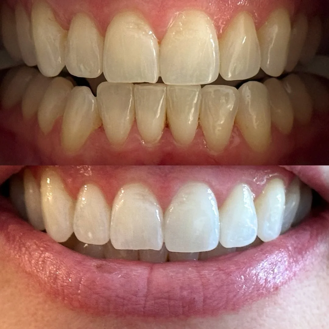 The Ultra White Treatment - Session 1 &amp; 2 for gorgeous Amy ✨ ⁣
⁣⁣
⁣Two seperate sittings (one week apart) to achieve your whitest shade possible. Book now via the link in bio.