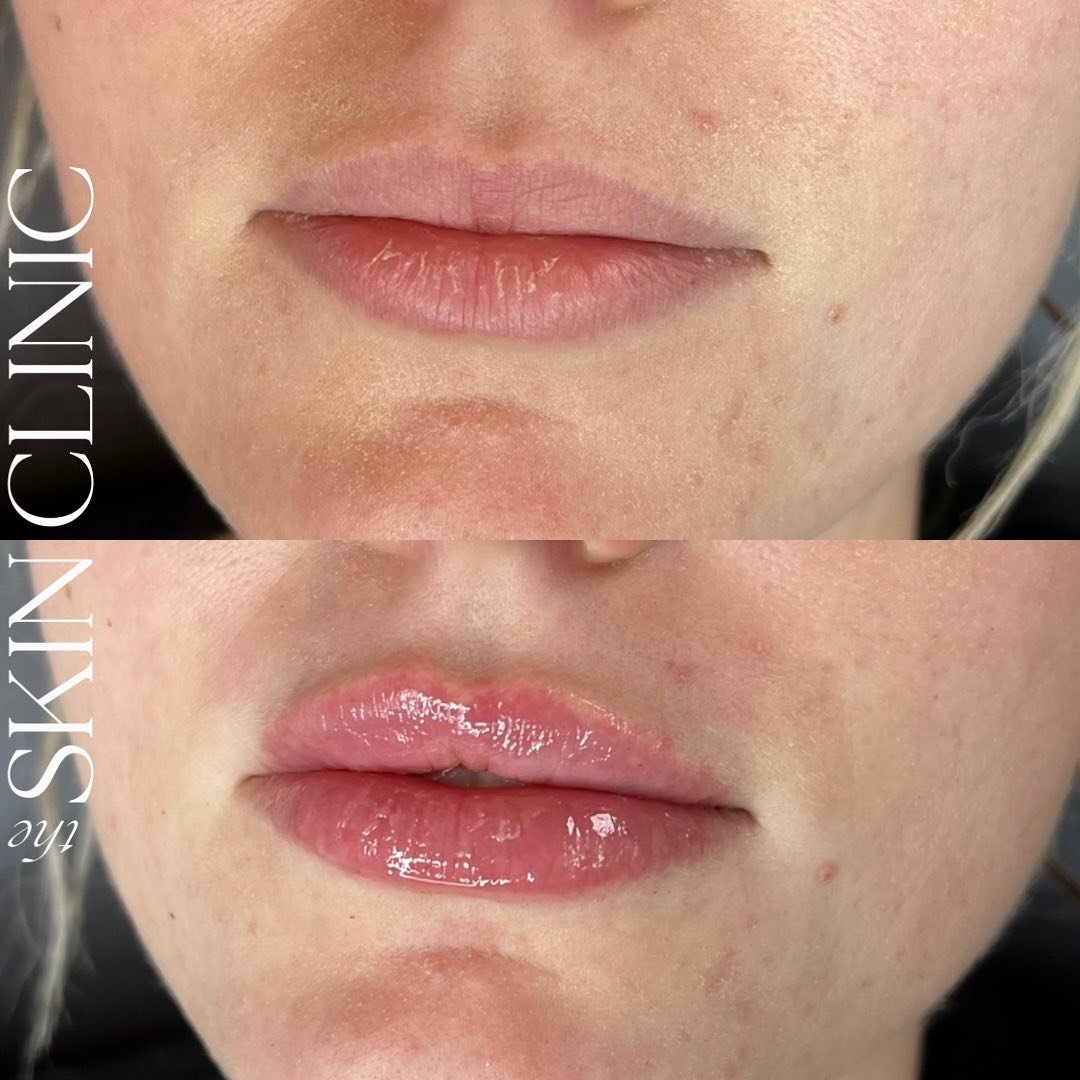 𝗟𝗜𝗣 𝗙𝗜𝗟𝗟𝗘𝗥 💉

𝗜𝗻𝘁𝗲𝗿𝗲𝘀𝘁𝗲𝗱 𝗶𝗻 𝘁𝗵𝗶𝘀 𝘁𝗿𝗲𝗮𝘁𝗺𝗲𝗻𝘁? 𝗕𝗼𝗼𝗸 𝗮 𝗳𝗿𝗲𝗲 𝗰𝗼𝗻𝘀𝘂𝗹𝘁𝗮𝘁𝗶𝗼𝗻!📱

📍 𝗧𝗵𝗲 𝗦𝗸𝗶𝗻 𝗖𝗹𝗶𝗻𝗶𝗰 - 𝗖𝗵𝗮𝘁𝗵𝗮𝗺 &amp; 𝗪𝗮𝗹𝗹𝗮𝗰𝗲𝗯𝘂𝗿𝗴 
📱𝗖𝗮𝗹𝗹/𝗧𝗲𝘅𝘁: (𝟱𝟭𝟵) 𝟯𝟲𝟱-𝟲𝟮?