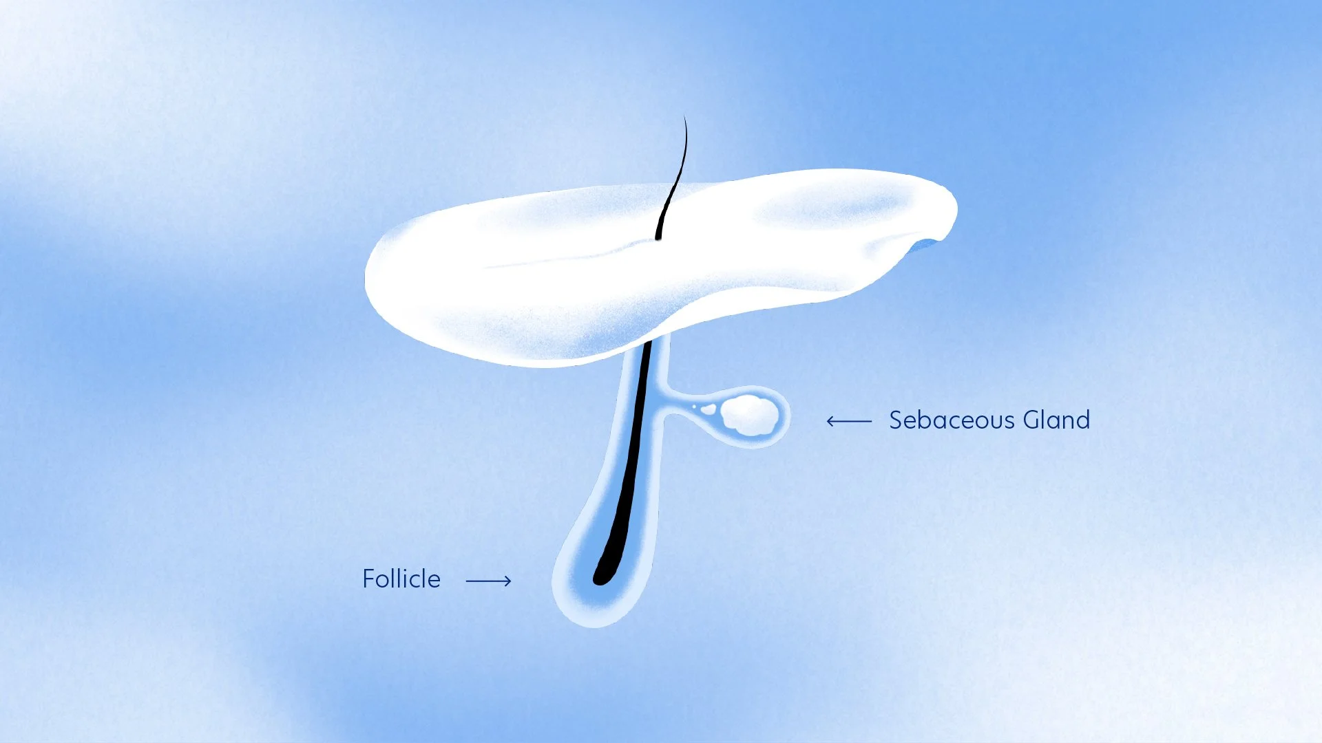 Diagram of a hair follicle showing the sebaceous gland, follicle, and hair shaft against a blue background.
