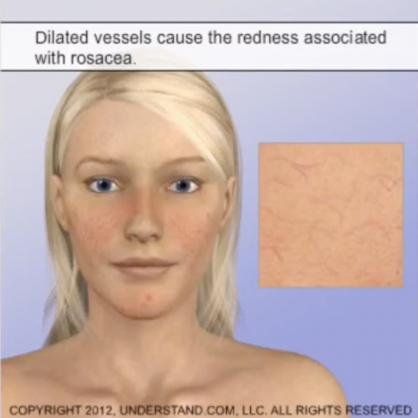 A woman with fair skin and freckles showing redness on her face; text explains dilated vessels cause redness in rosacea; inset shows close-up of skin with visible blood vessels.
