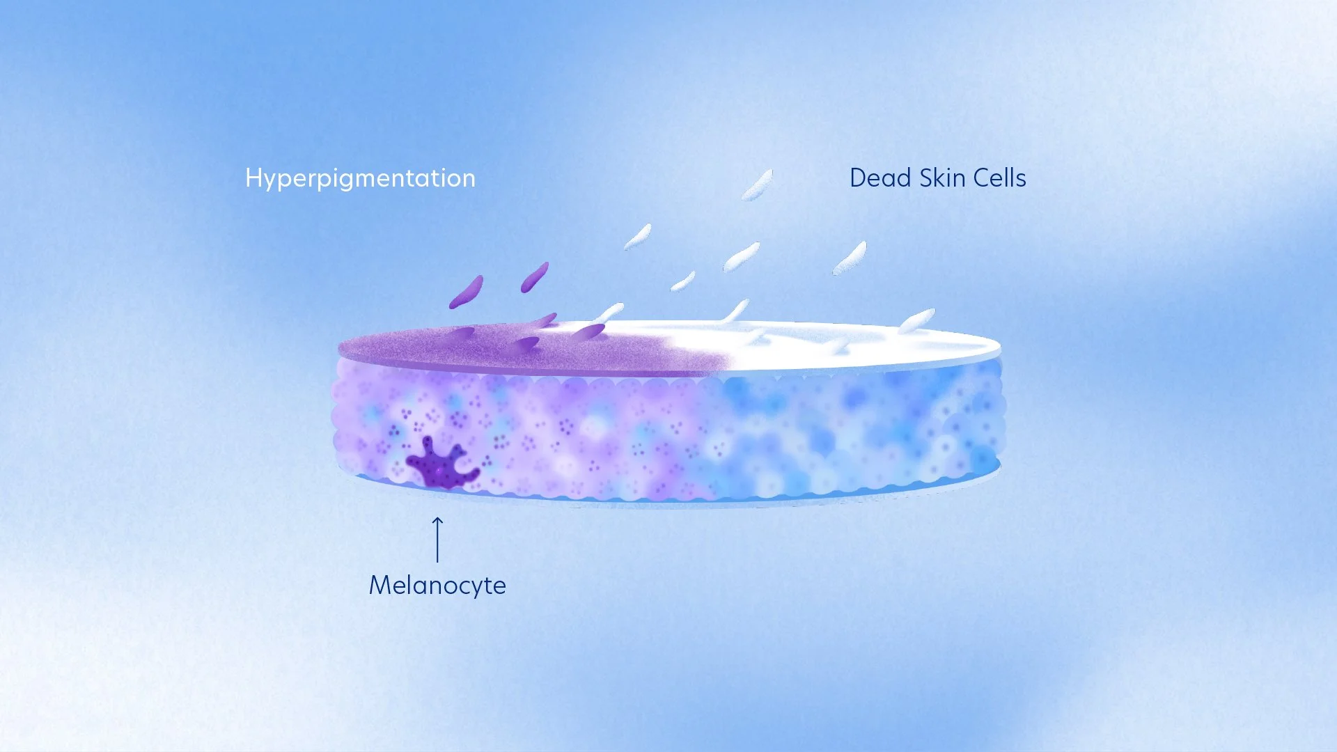 An illustration showing the process of skin pigmentation change. It depicts a melaninocyte cell producing melanin, with dead skin cells and areas of hyperpigmentation.