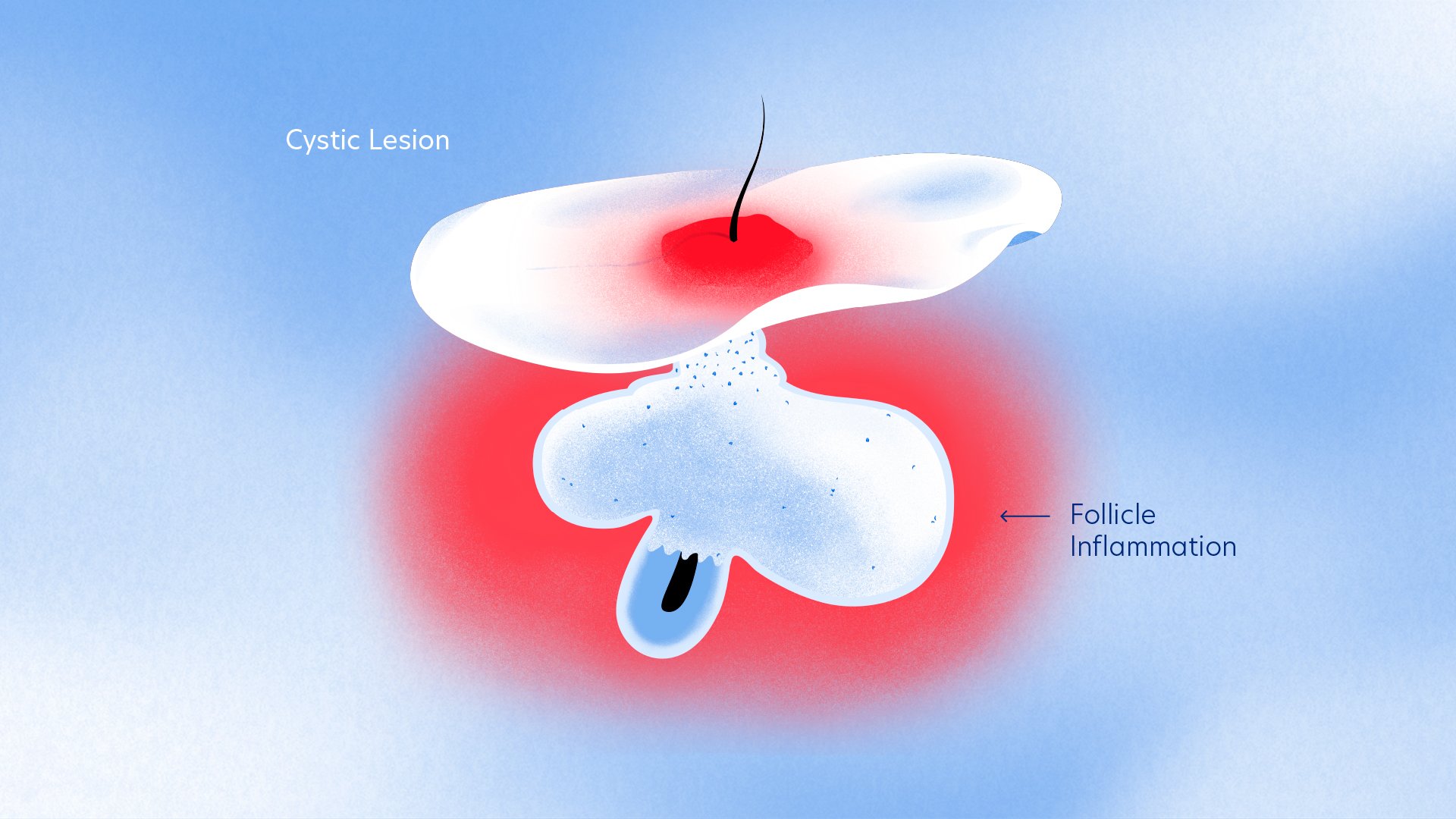 Diagram of a cystic lesion and follicle inflammation in the skin, showing a cystic lesion with redness and a follicle with inflammation.