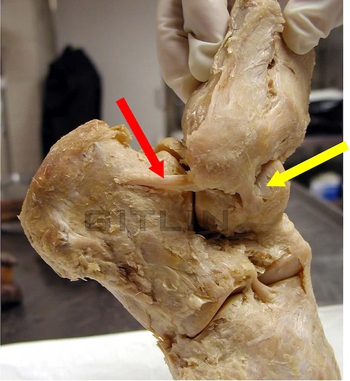 ANKLE LIGAMENT TEAR BROSTRUM GOULD REPAIR