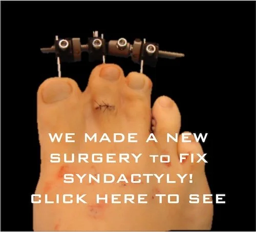 syndactyly toes stuck together foot hammertoes florida new york