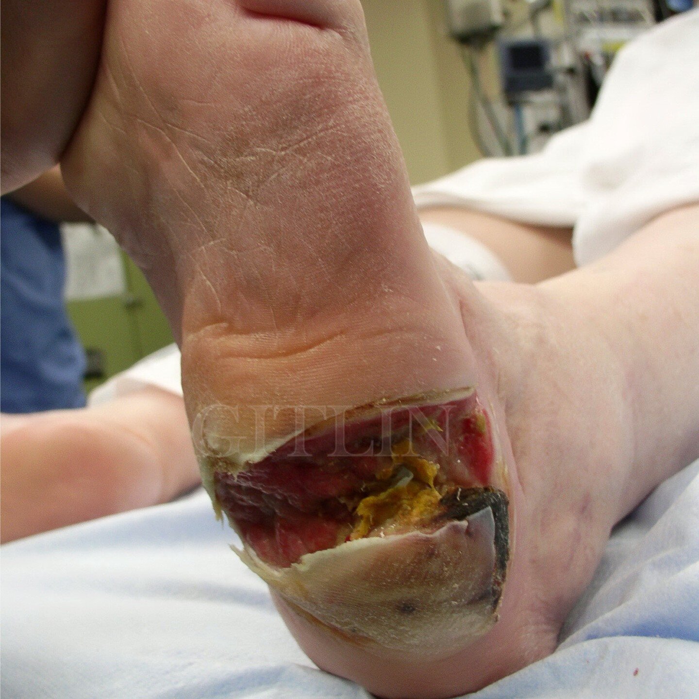 Diabetic wound healed with new flap.

#surgery #footsurgery #diabeticfoot #woundcare #skingraft #footdoctor #footsurgeon #podiatry #drdavidgitlin