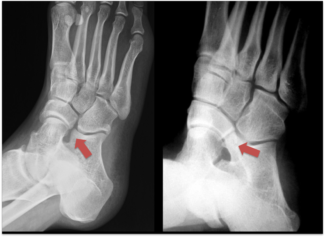 Tarsal Coalition Foot Ankle — Foot Ankle Surgery
