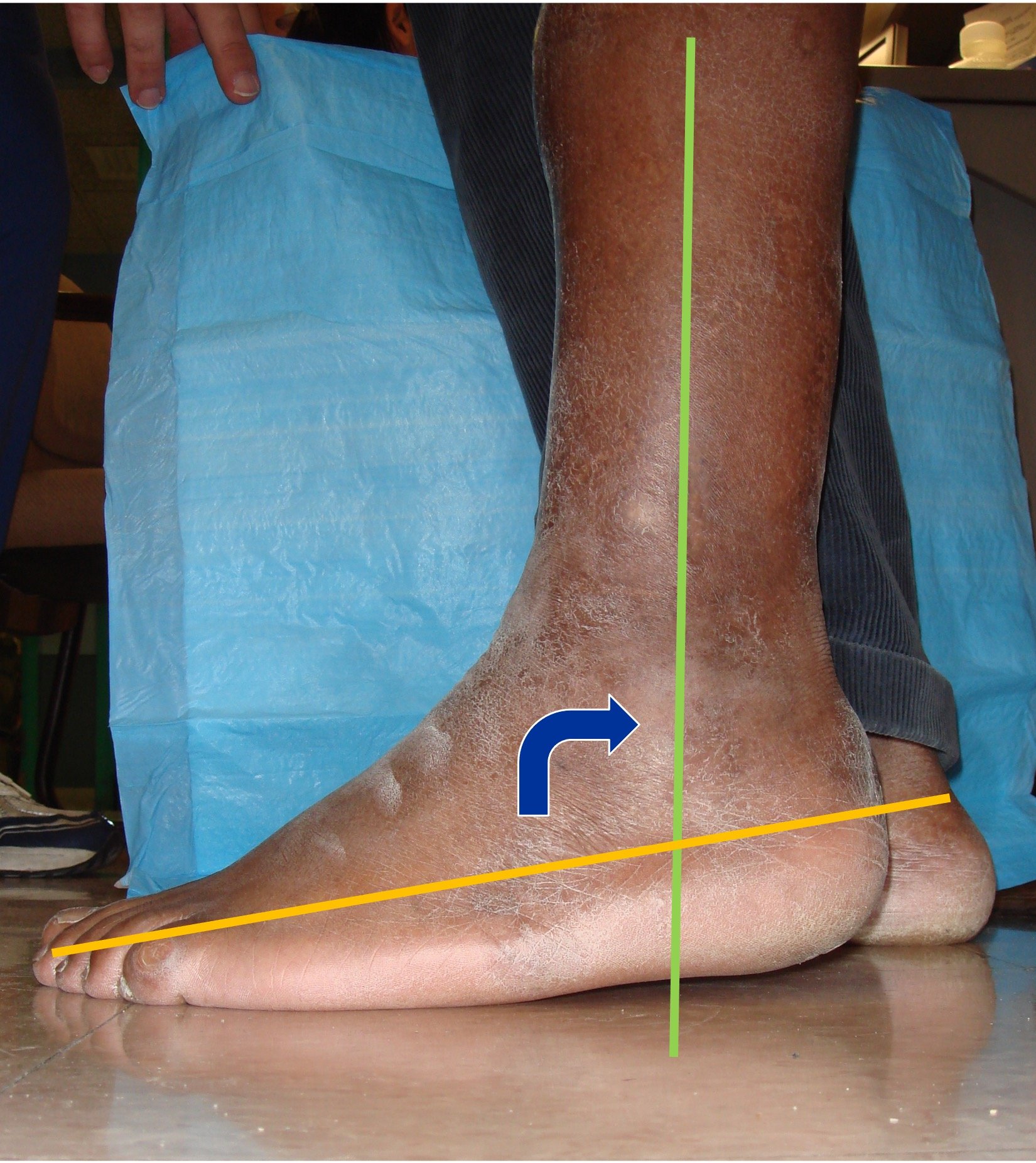 Does Your Foot Hurt Here?: The Heel