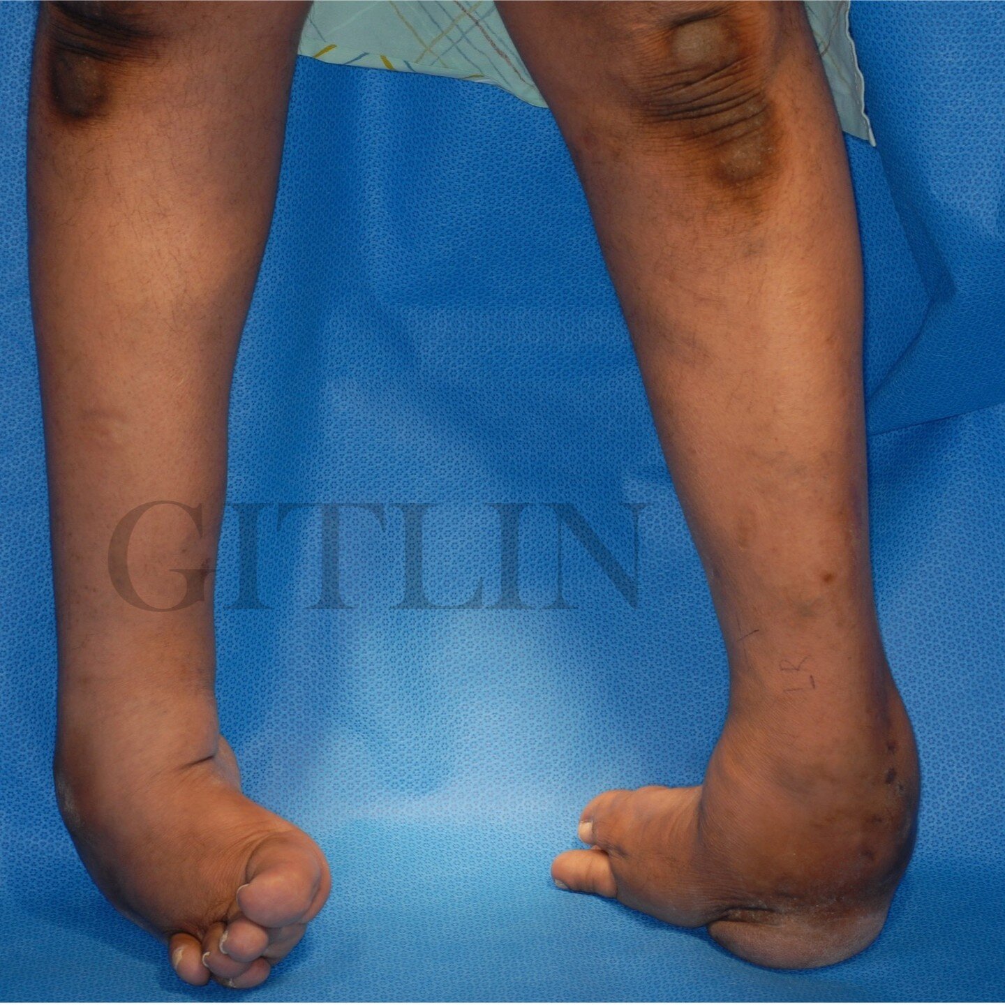 Part 2 (before and after) lets fix the right foot on our 38 year old Clubfoot patient. We are using a similar no incision ilizarov technique on the right foot that we used in the left foot. He was born with clubfoot and his family didn't have the mea