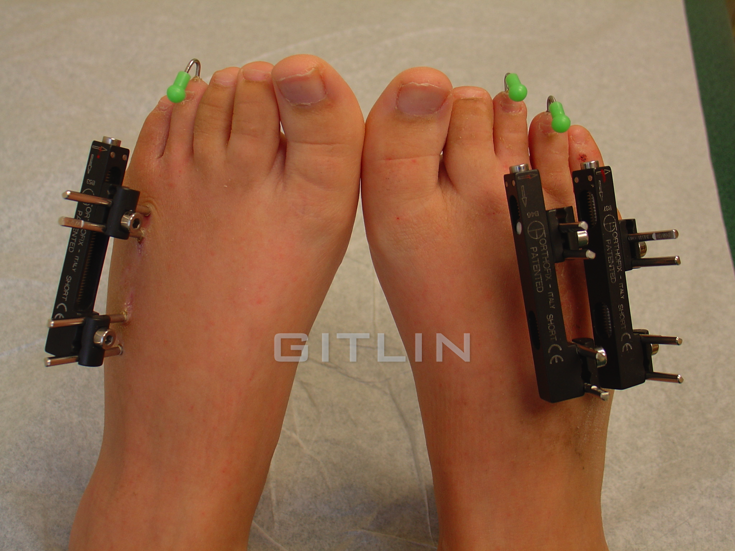 brachymetatarsia foot