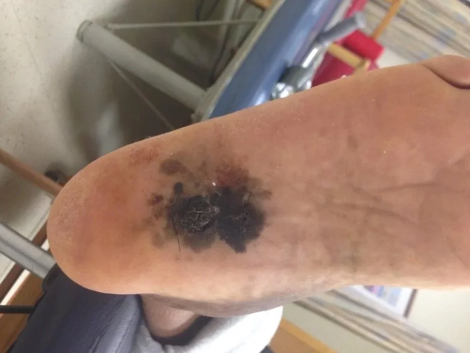 Close-up of a foot with a large, dark, necrotic cancer of the foot