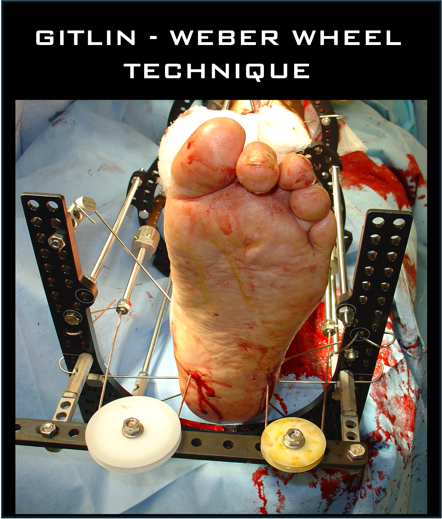 gitlin weber wheel ilizarov technique bone transport