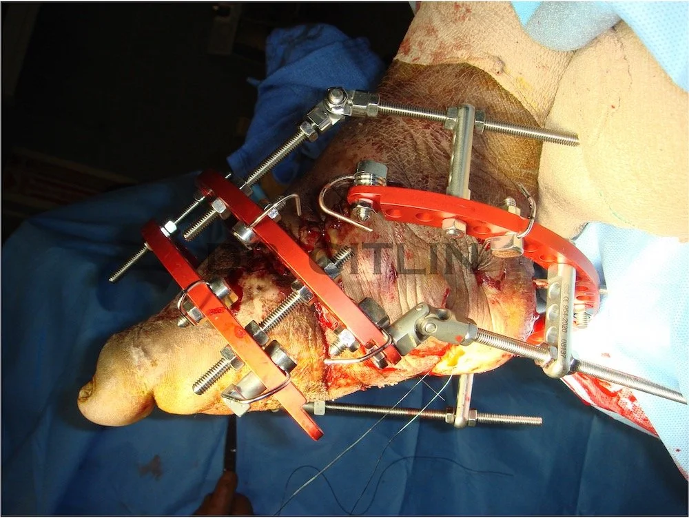 charcot external fixation wound surgery