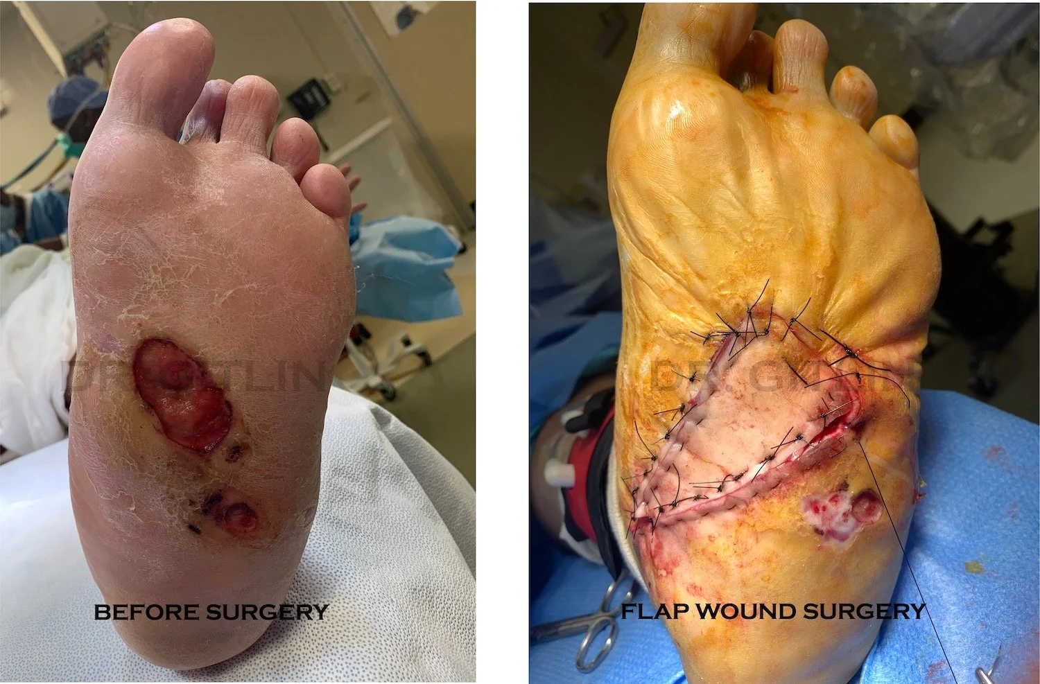 DIABETIC FOOT ULCER ROCKERBOTTOM CHARCOT WOUND SURGERY