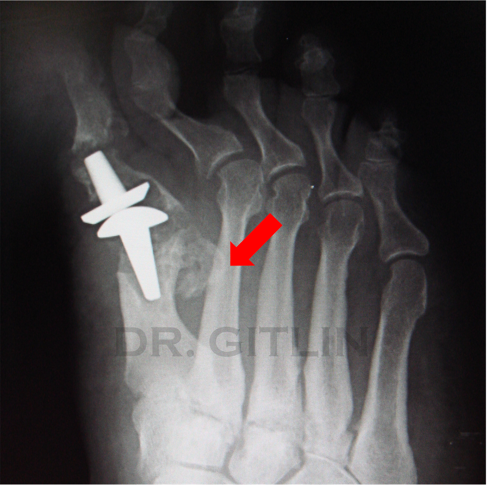FOOT IMPLANT FAILURE FLORIDA NEW YORK