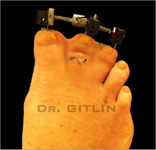 DESYNDACTYLIZATION SURGERY HAMMERTOE