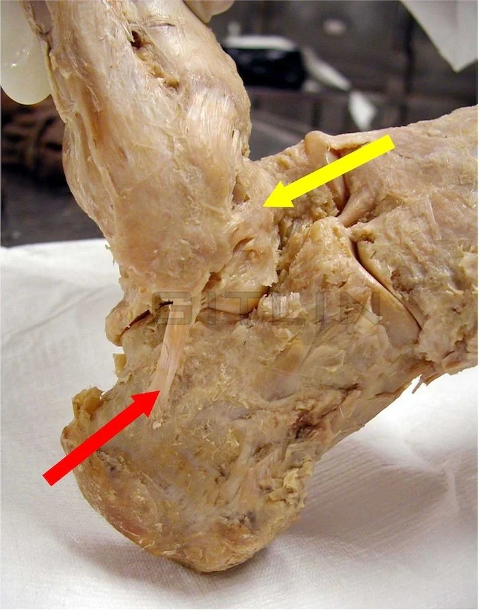 ANKLE LIGMANT ATFL CFL SPRAIN CADAVER