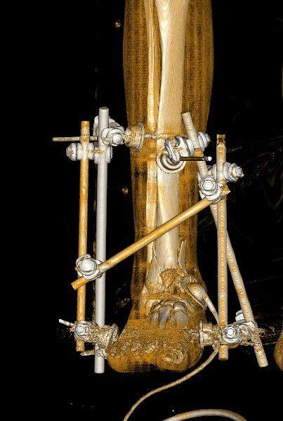 external fixation foot ankle surgery