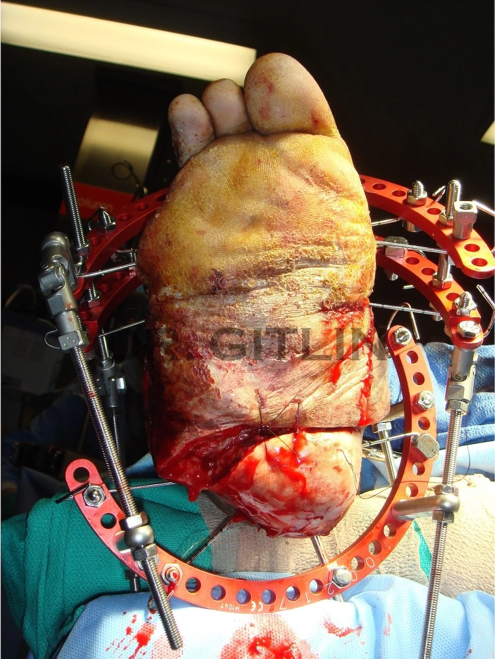 charcot foot large wound limb salvage surgery