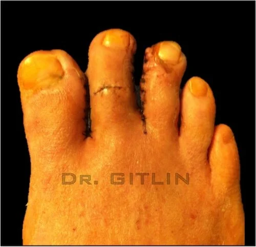 DESYNDACTYLIZATION SURGERY HAMMERTOE NEW YORK FLORIDA
