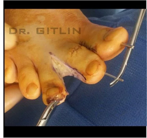 DESYNDACTYLIZATION SURGERY HAMMERTOE NAPLES FLORIDA