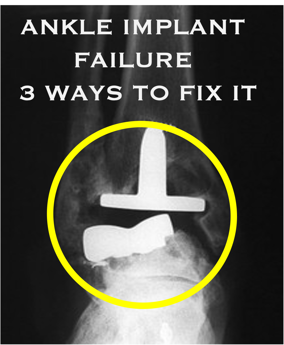 ANKLE IMPLANT FAILURE FLORIDA LOGO.png